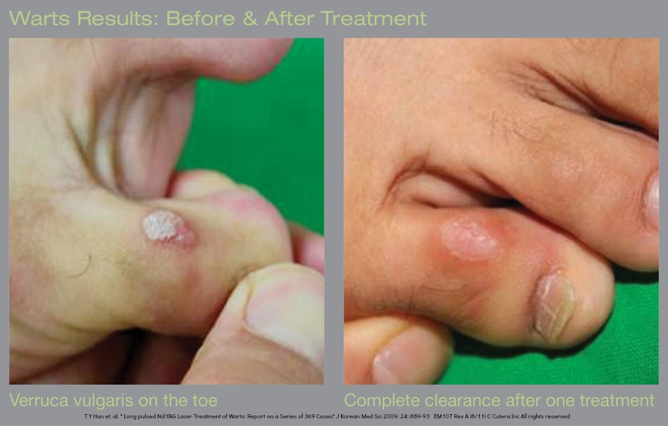 Plantar Wart Treatment &amp; Removal Perth - Feet First Podiatry